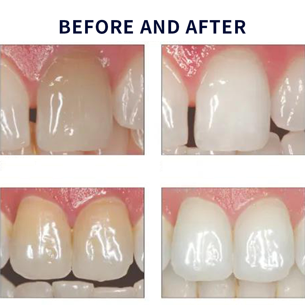 유백광 미백 20% PF 20 16 젤 키트, 초강력  - Teeth Whitening App 리뷰 및 가격