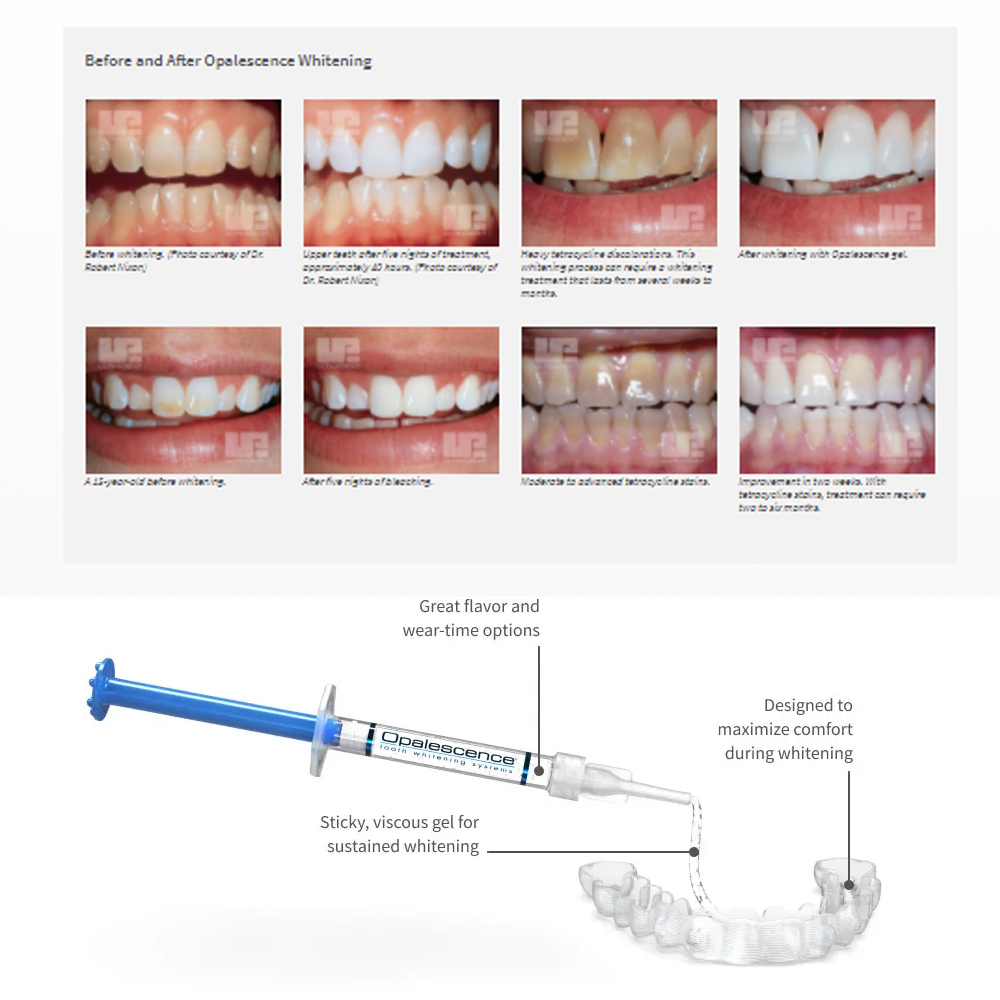 유백광 미백 20% PF 20 16 젤 키트, 초강력  - Teeth Whitening App 리뷰 및 가격