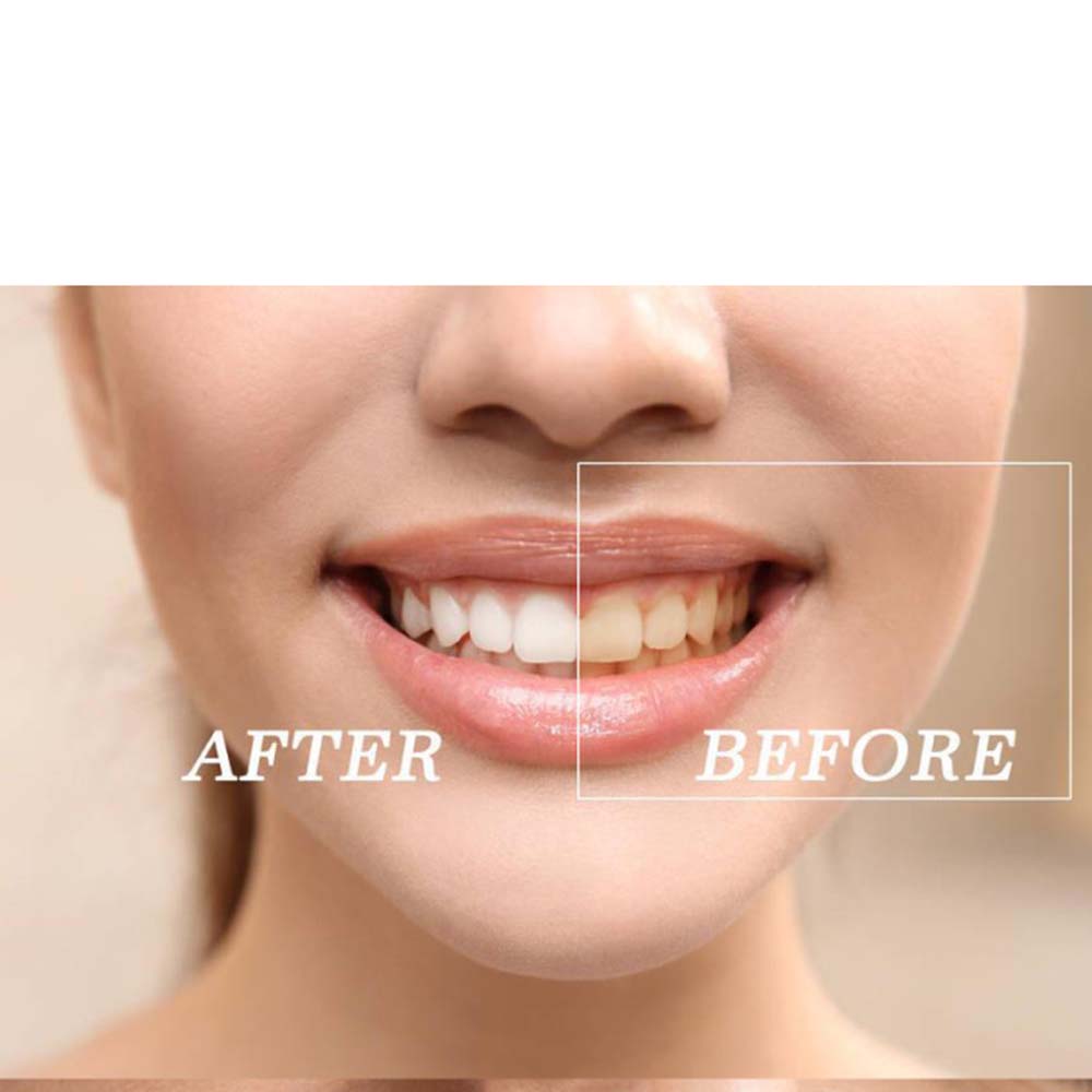 최고 품질의 과산화물 치아 미백 젤 키트 표백 시스템  - Teeth Whitening Kit With Light 리뷰 및 가격